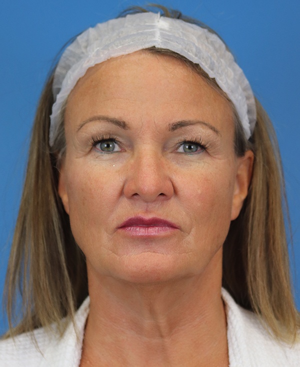 Facelift Before