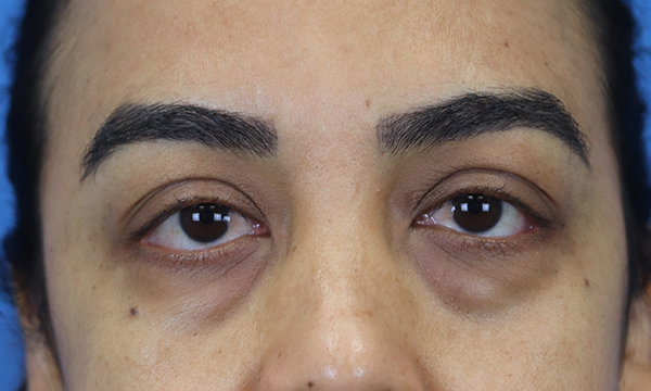 blepharoplasty before