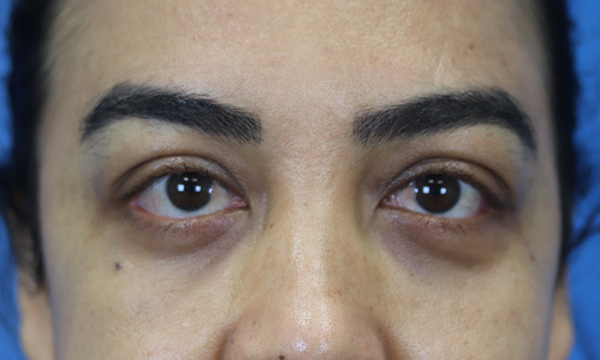 blepharoplasty after