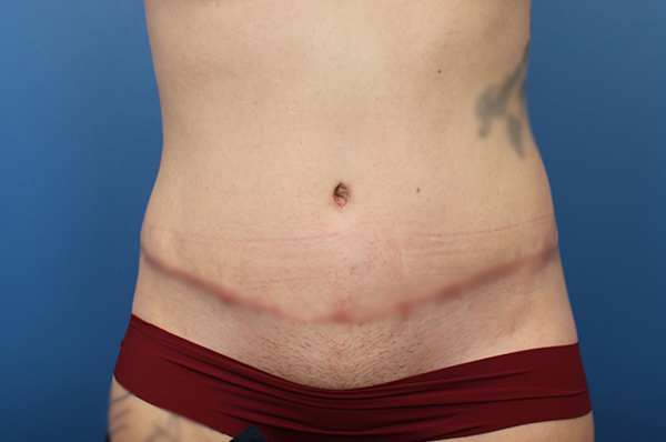 Abdomen with visible scarring, highlighting post-surgery results by Daniela Atencio, MD.