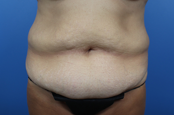 Abdominal area highlighting skin texture and contour for cosmetic consultation.