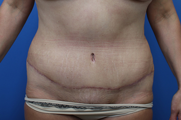 Abdominal skin texture and scarring post-surgery, showcasing patient results.
