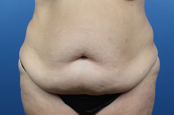 Abdominal area highlighting skin texture and contour for medical evaluation.