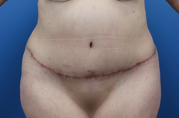 Abdominal contour after surgical procedure, showcasing professional results by Daniela Atencio, MD.