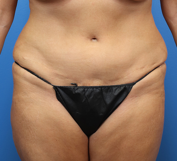 Liposuction Before