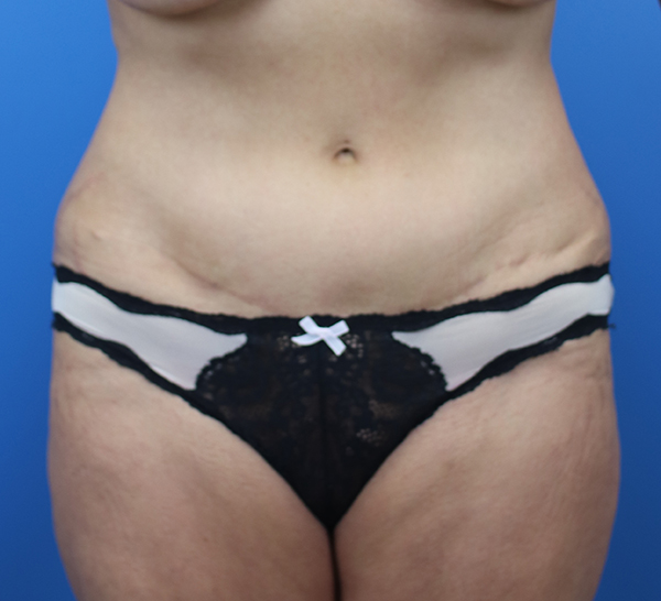 Liposuction After