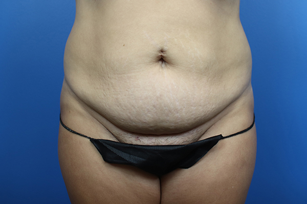 Abdominoplasty Before