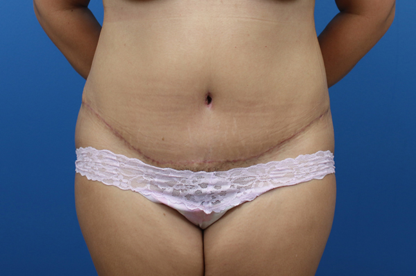 Tummy Tuck After