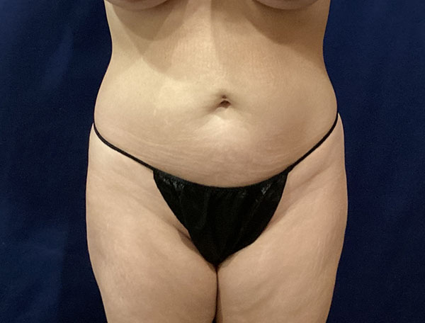 Patient in black thong, showcasing body contouring results.