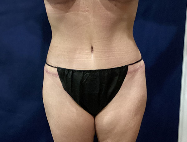 Patient's abdomen post-procedure, highlighting surgical results and recovery.