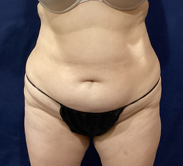 Patient's midsection highlighting body contouring results.