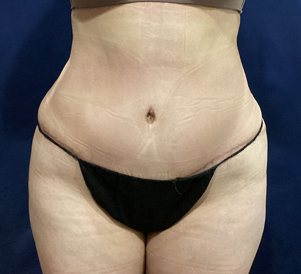 Abdomen with visible stretch marks, highlighting body confidence and wellness.