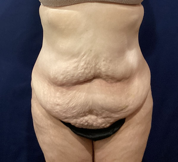 Abdomen with skin texture changes, relevant for body contouring discussions.
