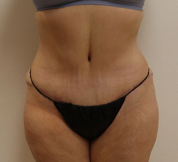 Patient's abdomen post-treatment, showcasing skin texture and contouring results.