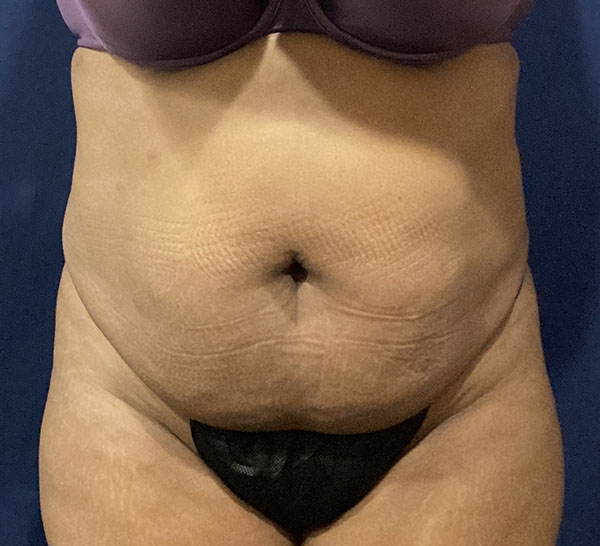 Abdomen close-up highlighting skin texture and contour for medical assessment.