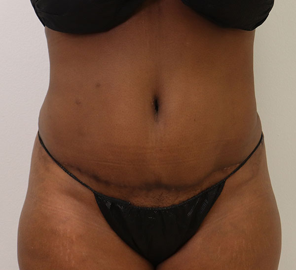 Patient's midsection highlighting skin texture and contour for consultation.