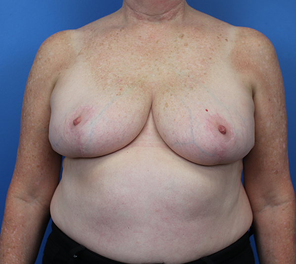 Breast examination with clear skin tone against a blue background, highlighting professionalism.