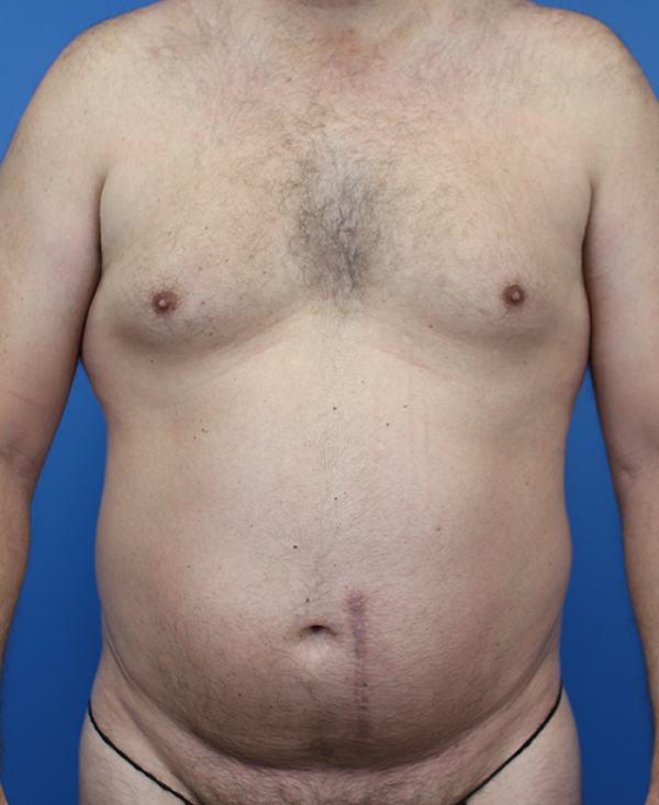 Male torso with visible scars, highlighting post-surgical results.