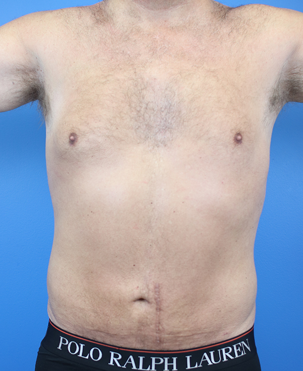 Male torso with surgical scar, showcasing post-operative results in a clinical setting.
