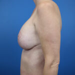 Profile view of a patient post-surgery, showcasing results in a clinical setting.