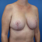 Post-operative breast enhancement by Daniela Atencio, MD, against a blue background.