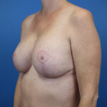 Post-operative breast reconstruction by Daniela Atencio, MD, showcasing results.