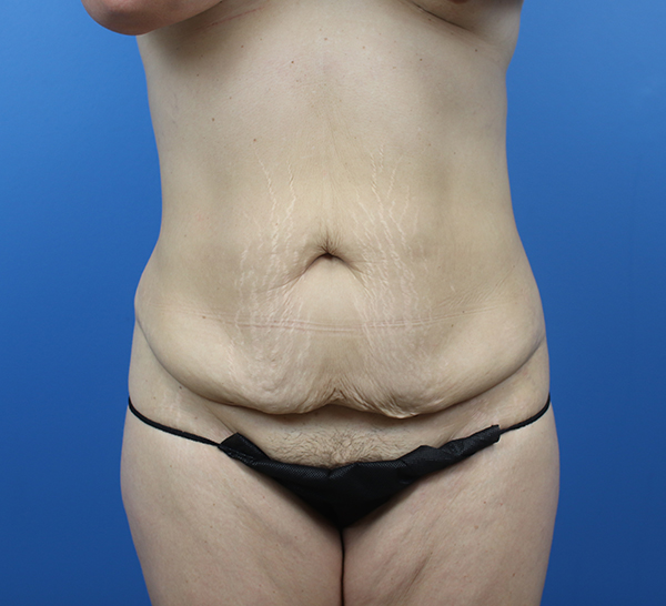Abdominal area with stretch marks, highlighting body confidence and wellness.
