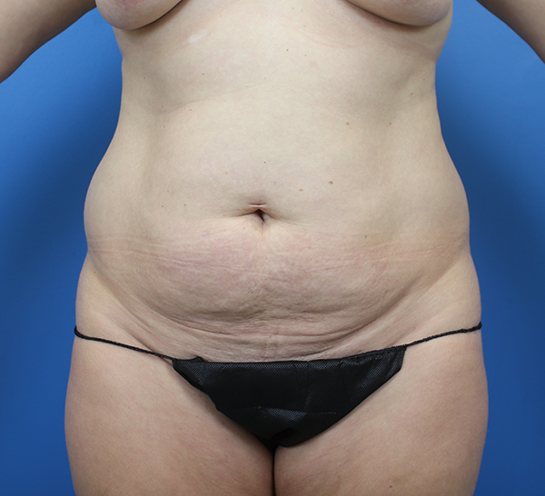 Body contouring results highlighting skin texture and abdominal area.