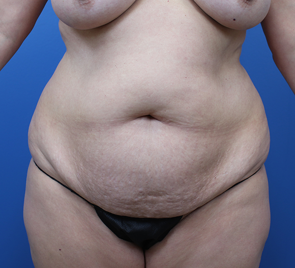 Patient's abdomen highlighting skin texture and body contours.