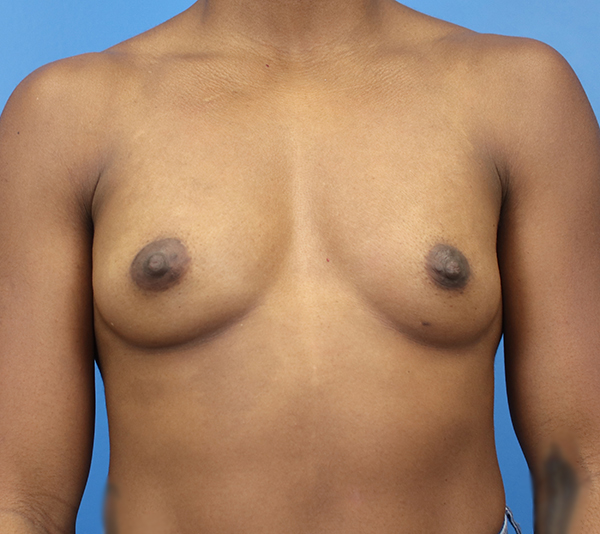 Patient's chest, showcasing natural anatomy, reflecting professional care by Daniela Atencio, MD.
