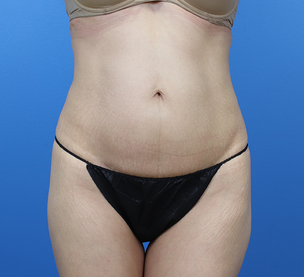 Patient's abdomen showcasing skin texture and contour for consultation.