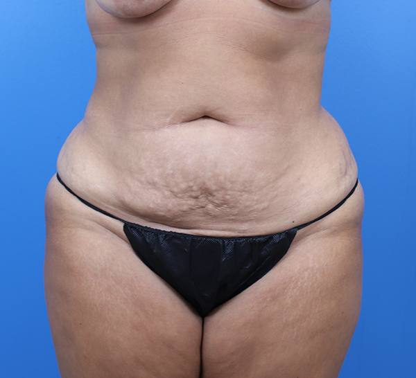 Patient consultation highlighting body contouring results.