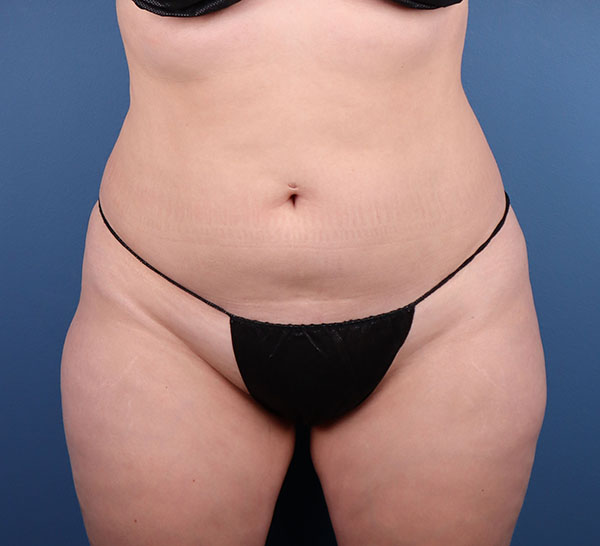 Body contouring patient showcasing results in professional clinic setting.