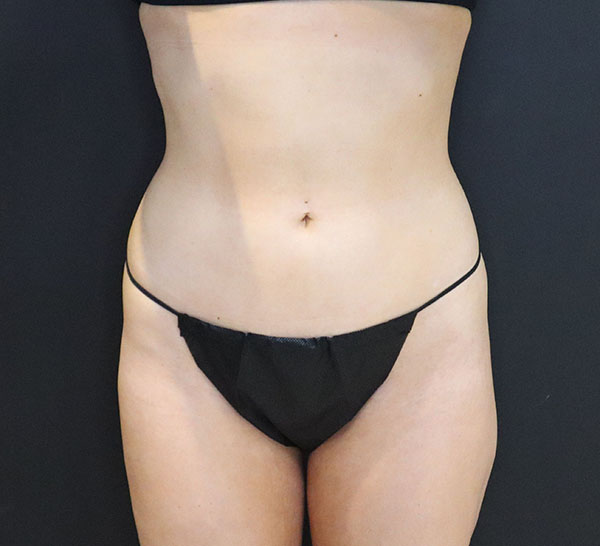 Patient in black swimwear, showcasing body contouring results.