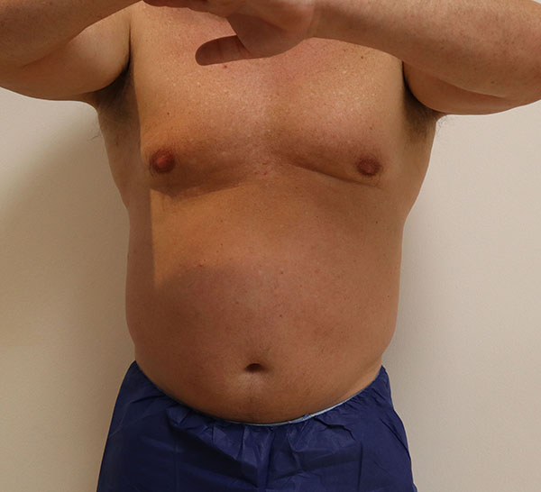Male patient in medical attire, showcasing abdominal area for examination.