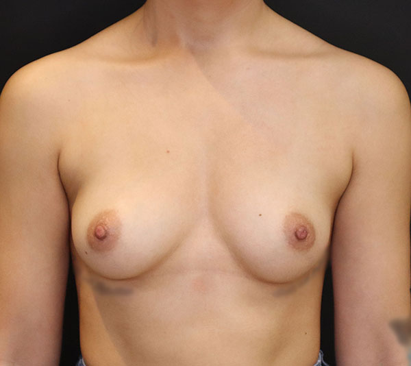 Breast examination highlighting natural anatomy for patient education.