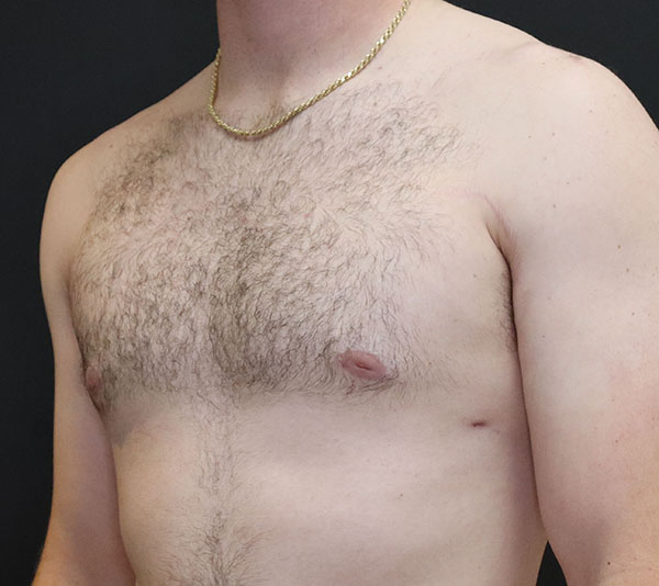 Male torso with chest hair, highlighting general health and wellness.