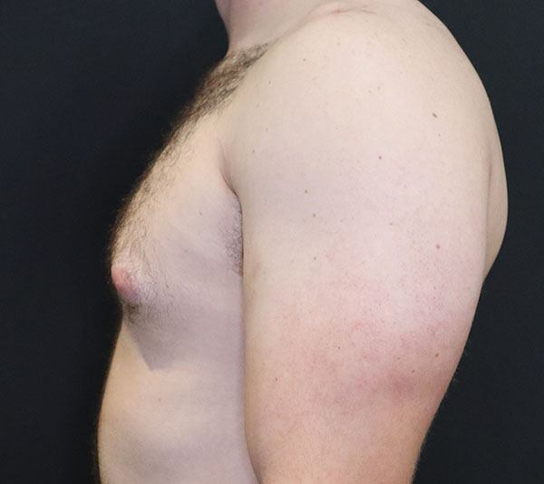 Male torso side view highlighting skin health and body aesthetics.