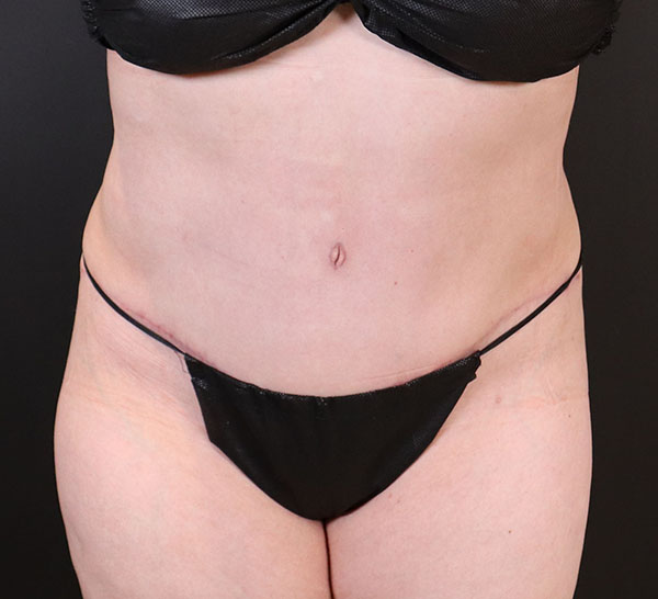 Abdominoplastia y liposucción después de la foto de la paciente 240198
