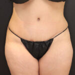 abdominoplastia y Liposucción después de la foto