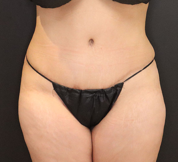 abdominoplastia y Liposucción después de la foto