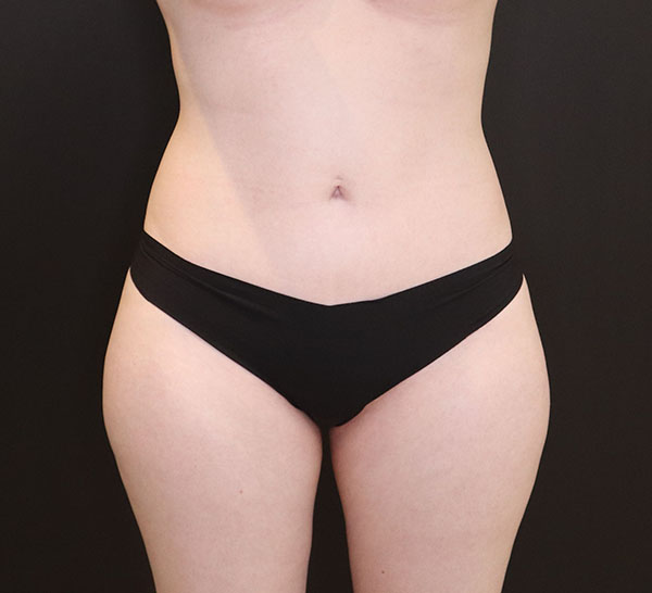 liposucción de abdomen superior e inferior, cintura y flancos después de foto.