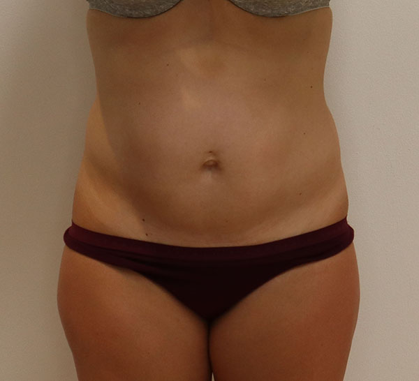 abdominoplastia y Liposucción de abdomen, cintura y flancos antes foto