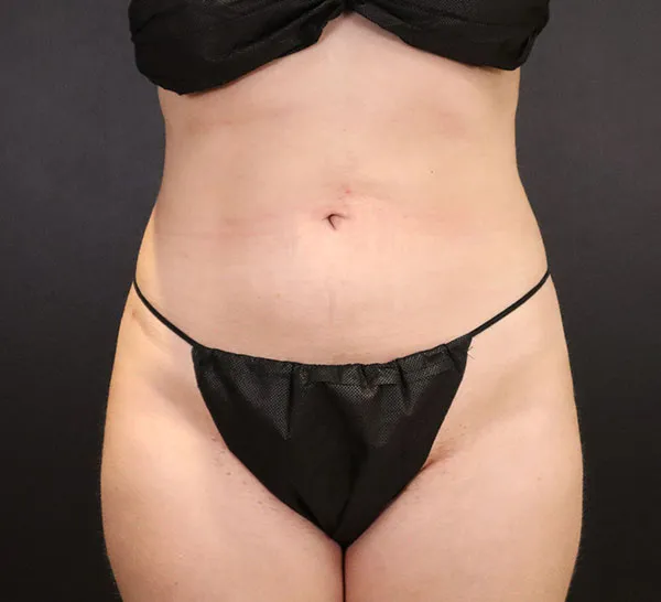 Front view of patient post-liposuction, showcasing smooth abdominal contour.