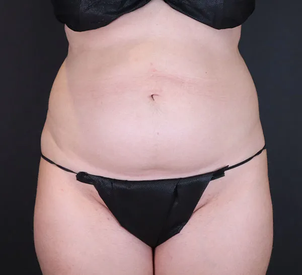 Front view of patient before liposuction procedure, highlighting abdominal area.