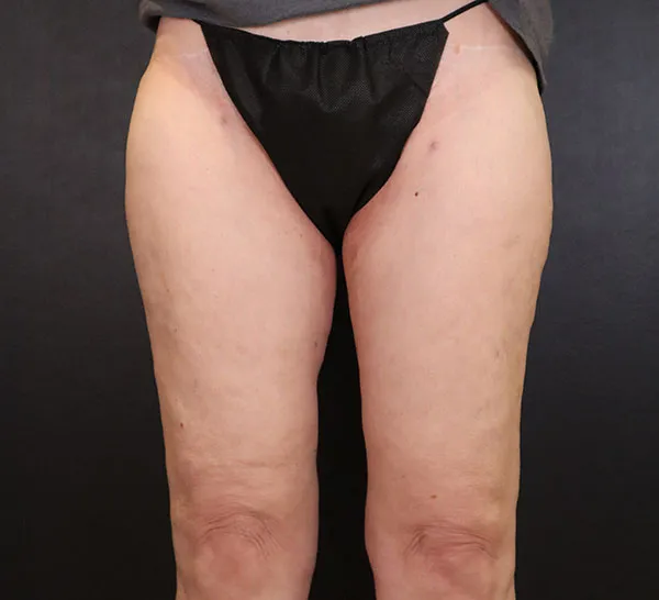 Front view of patient after successful liposuction procedure by Dr. Daniela Atencio.