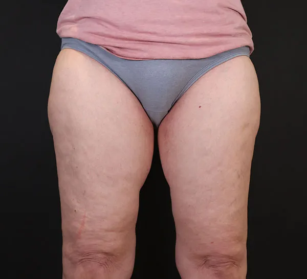 Front view of thighs before liposuction, highlighting skin texture and contours.