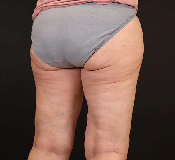 Before liposuction, highlighting areas of concern on the thighs and buttocks.
