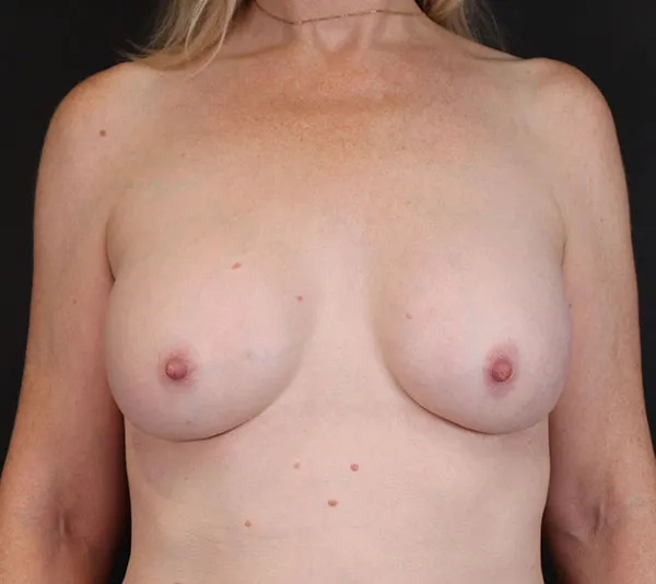 front view after breast implant exchange by Daniela Atencio MD