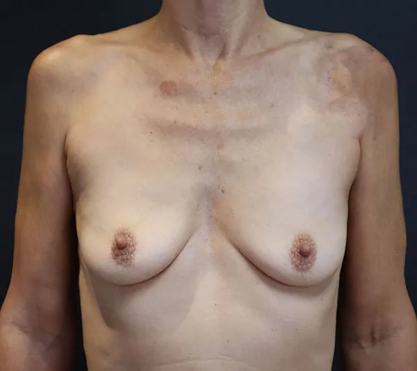 front view before breast augmentation by Daniela Atencio MD